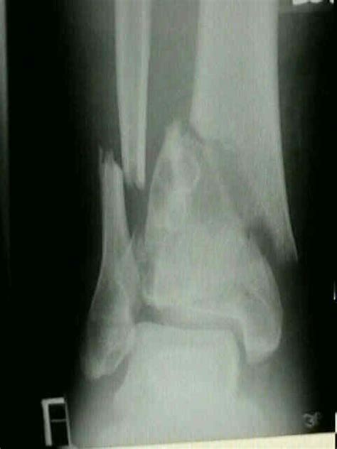 Tibial Plafond Fracture Wheeless Textbook Of Orthopaedics