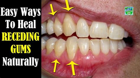 How To Fix Receding Gums At Home