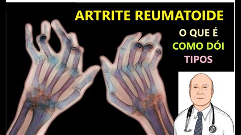 Dores Da Artrite Reumatoide Causas Tipos E Diagnóstico Precoce Youtube