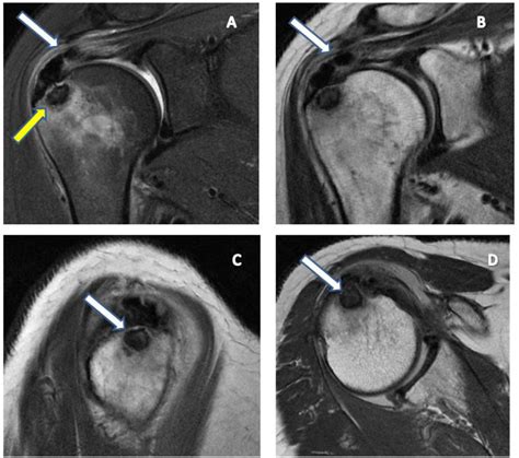 Figure 1 From MRI Findings In Intraosseous Extension Of Calcific