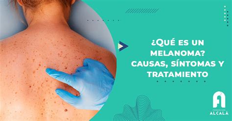 ¿qué Es Un Melanoma Causas Y Síntomas Formación Alcalá