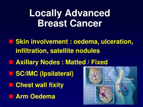 Ppt Recent Developments In Treatment Of Breast Cancer Powerpoint