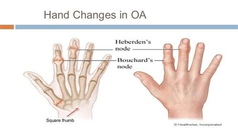 Oa Osteoarthritis Heberdens Vs Bouchards Nodes Osteoarthritis