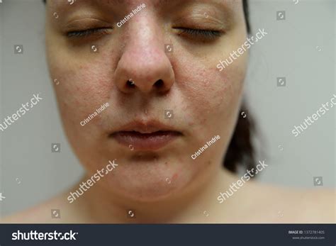 Atopic Dermatitis On Face Woman Stock Photo 1372781405 Shutterstock