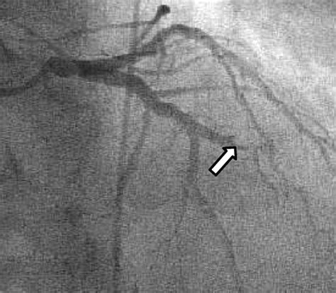 Acute Myocardial Infarction Due To Paradoxical Embolism Successful