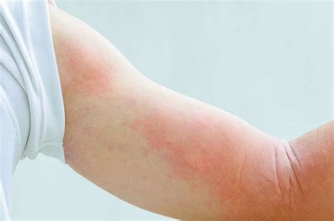 Skin Rash 10 Causes Of Skin Rashes