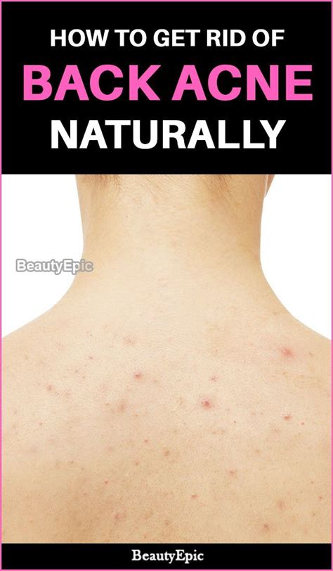 How To Get Rid Of Back Acne Fast Naturally Back Acne Remedies Back