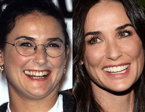 Celebs With The Most Dramatic Teeth Transformation Smilebar