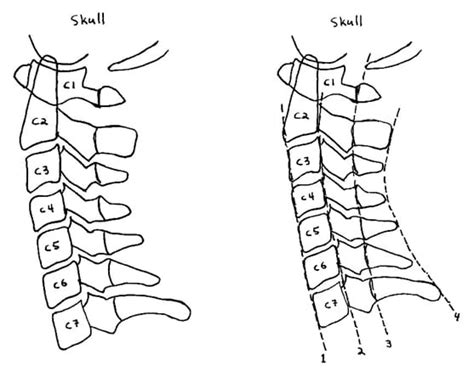 Cervical Spine Injury And Clinical Instability