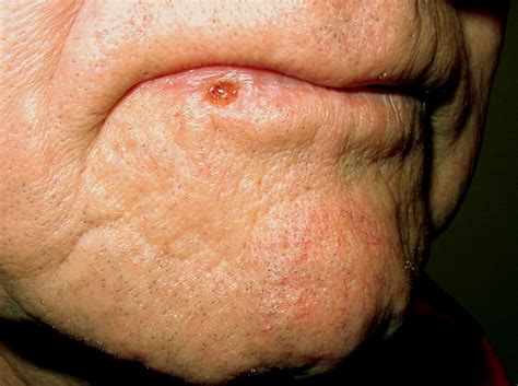 Skin Cancer On Lip From Smoking