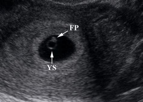 Early Pregnancy Ultrasound 3 Weeks Search Results Calendar 2015