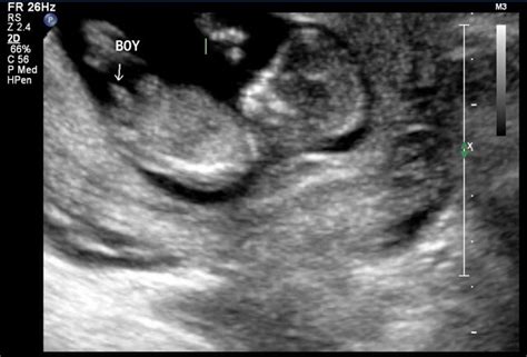 Us Tech Says Boy At 12 Week Nt Scan What Do You Think