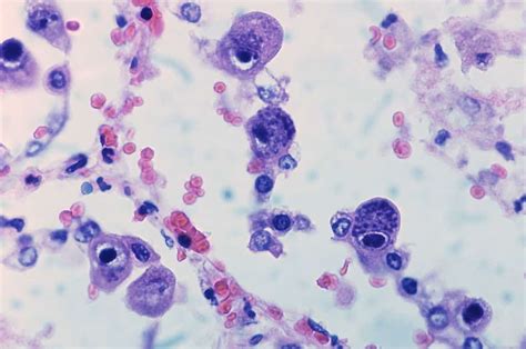 Le Cytomégalovirus Cmv Causes Symptômes Et Traitements