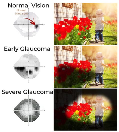 Glaucoma Madison Glaucoma Symptoms Anderson And Shapiro