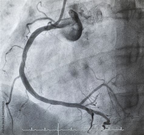 Coronary Angiogram Medical X Ray For Heart Disease Coronary Artery