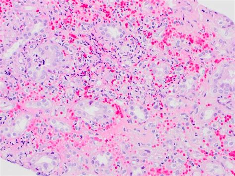 Pathology Outlines Eosinophilic Granulomatosis With Polyangiitis Egpa