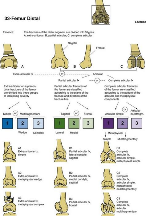 Chapter 80 distal femur fractures eric m. Distal Femur Fractures | Musculoskeletal Key
