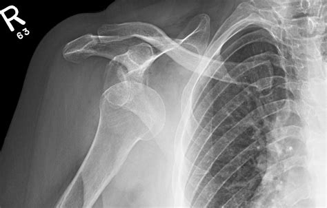 Anterior Glenohumeral Joint Dislocation Image