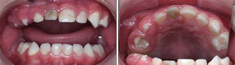Regional Odontodysplasia With Facial Cellulitis A Case Report And