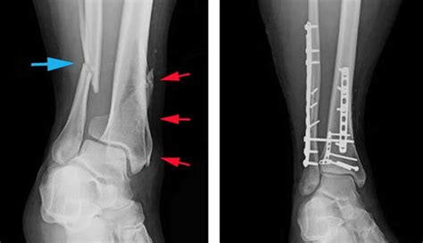 Tibial Shaft Fracture Causes Types Symptoms Diagnosis Treatment