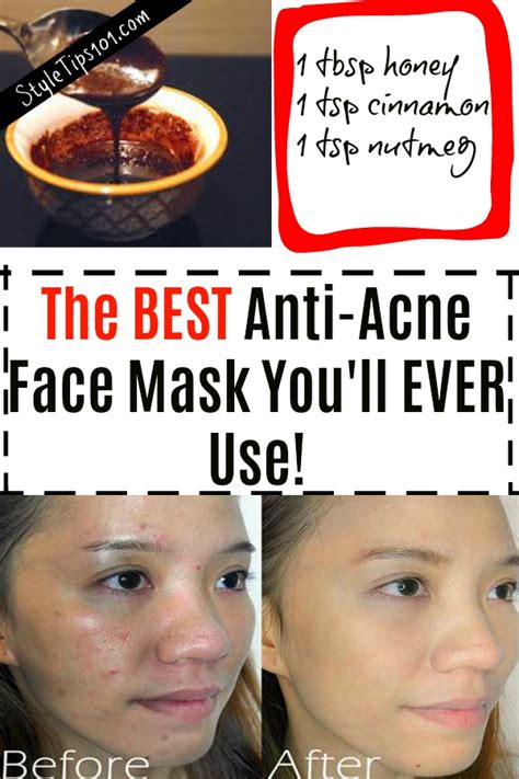 The Best Acne Face Mask Youll Ever Use