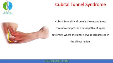 Cubital Tunnel Syndrome
