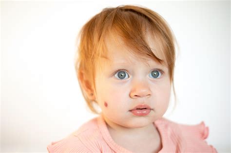 Understanding Baby Strawberry Birthmarks Causes Treatment And