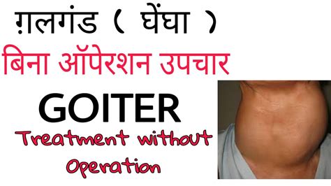 Treatment Of Goiter Without Operation । Best Medicine Of Goiter । गले
