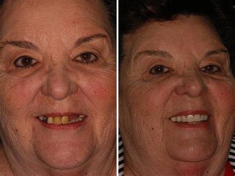 Fotos de Antes y Después de Implantes Dentales All on 4 Pac 68