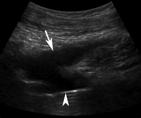 Common Sonographic Findings In The Painful Hip After Hip Arthroplasty