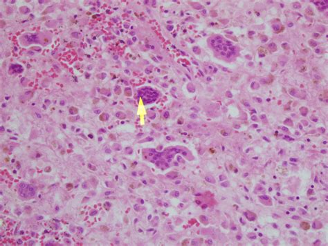 Central Giant Cell Granuloma Histology