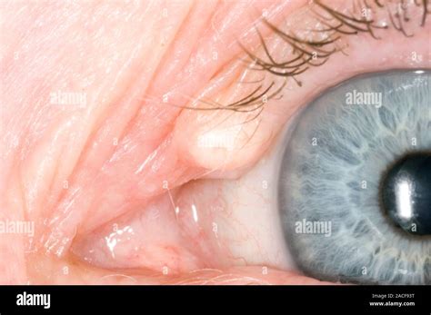 Cyst On A Patients Upper Eyelid This Is A Chalazion Or Meibomian