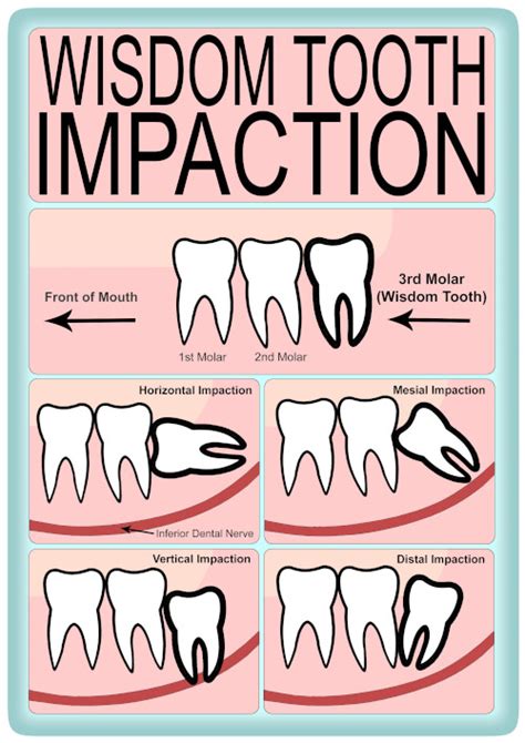 removal of impacted wisdom teeth british association of oral and maxillofacial surgeons