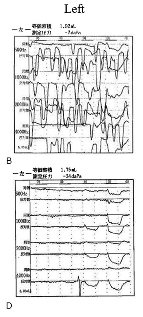 Middle Ear Myoclonus Dizziness