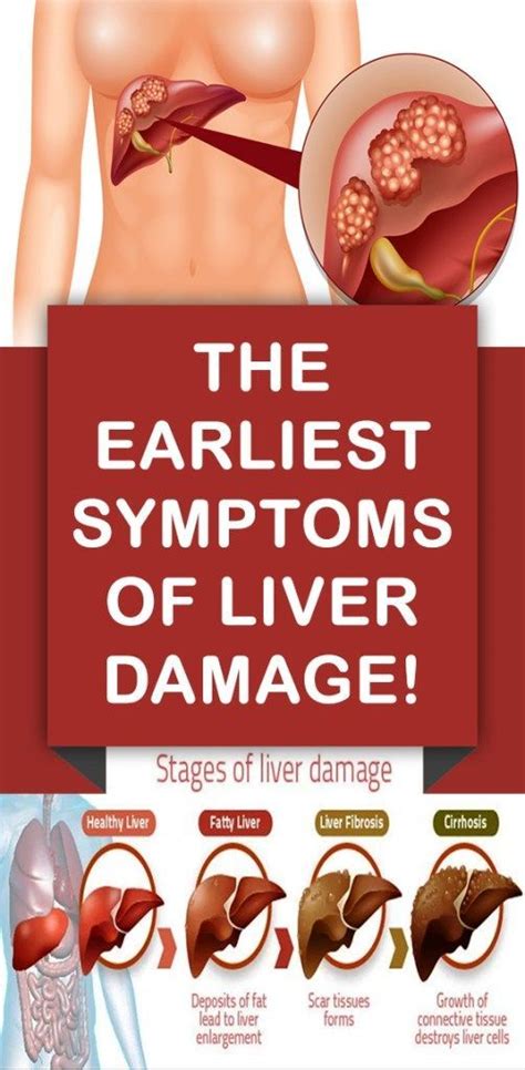 The Earliest Symptoms Of Liver Damage Healthy Facts Stomach