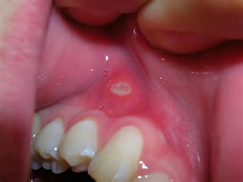 Mouth Ulcers Canker Sores Or Aphthous Stomatitis