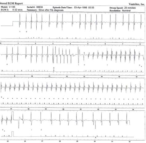 Icd 10 Cm Code For Intermittent Afib