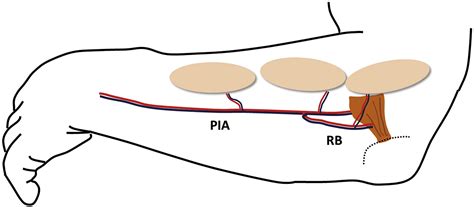 Fingertip Reconstruction With A Posterior Interosseous Artery