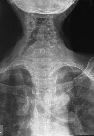 Mediastinal goiter | Image | Radiopaedia.org
