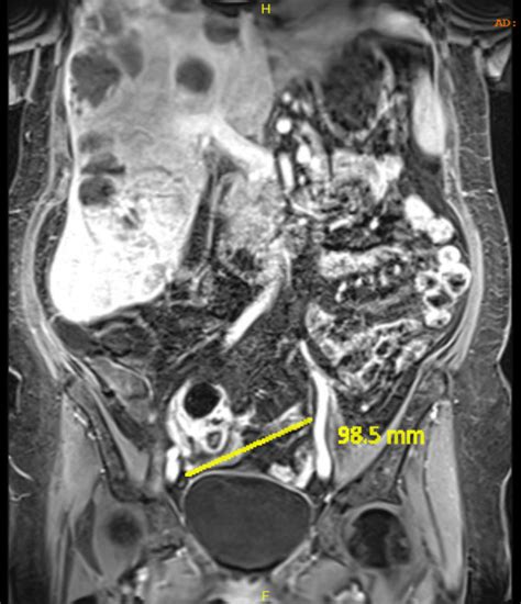 Mri Coronal Demonstrating Multiple Complex Liver Abscesses And
