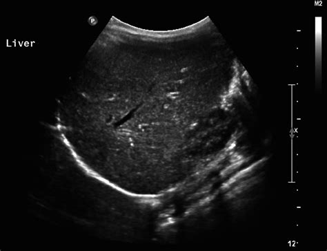 Post Treatment Ultrasound Showing Total Resolution Of The Liver Lesion