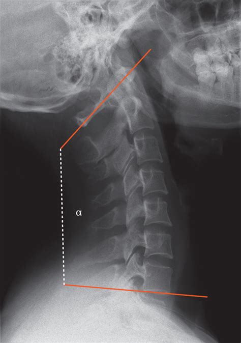 Healthy Cervical Spine Xray