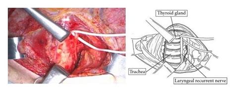 Neck Dissection For Thoracic Esophageal Squamous Cell Carcinoma