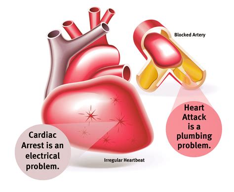 It is important to remember that a cardiac arrest is not the same as a heart attack. The difference between sudden cardiac arrest and heart ...