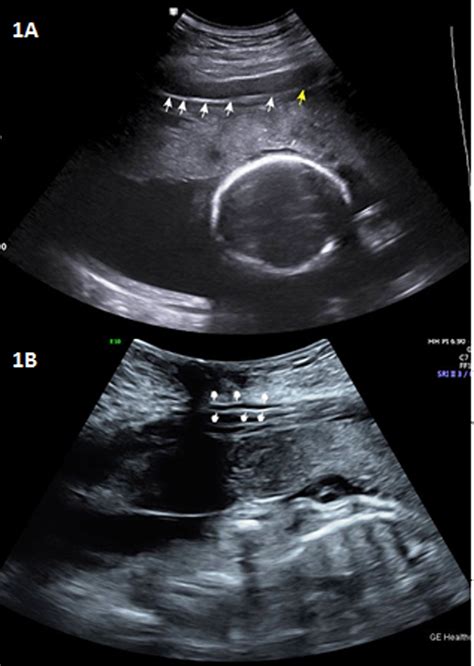 an unusual case of pregnancy in a patient with caroli s syndrome european journal of