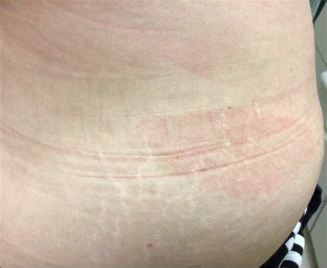 Clinical Challenge Nonpruritic Rash On Lower Back Mpr