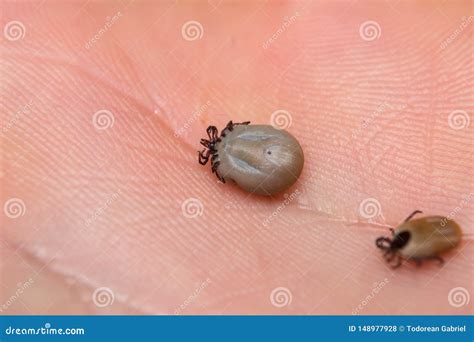 The Ticks On Human Skin Stock Photo Image Of Sick Medicine 148977928