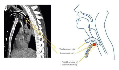 Pressure Necrosis From Tracheostomy Cuff Can Erode Innominate Artery To Download Scientific
