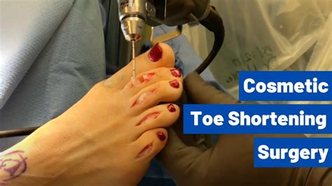 Cosmetic Toe Shortening Long Toe Surgery Video Without Metal Pins Youtube
