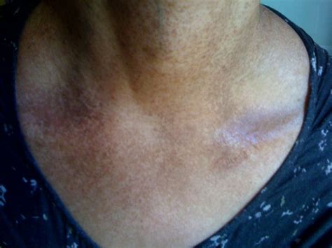 Dark patches of skin on the neck may be acanthosis nigricans. Dark spots on my neck and spreading